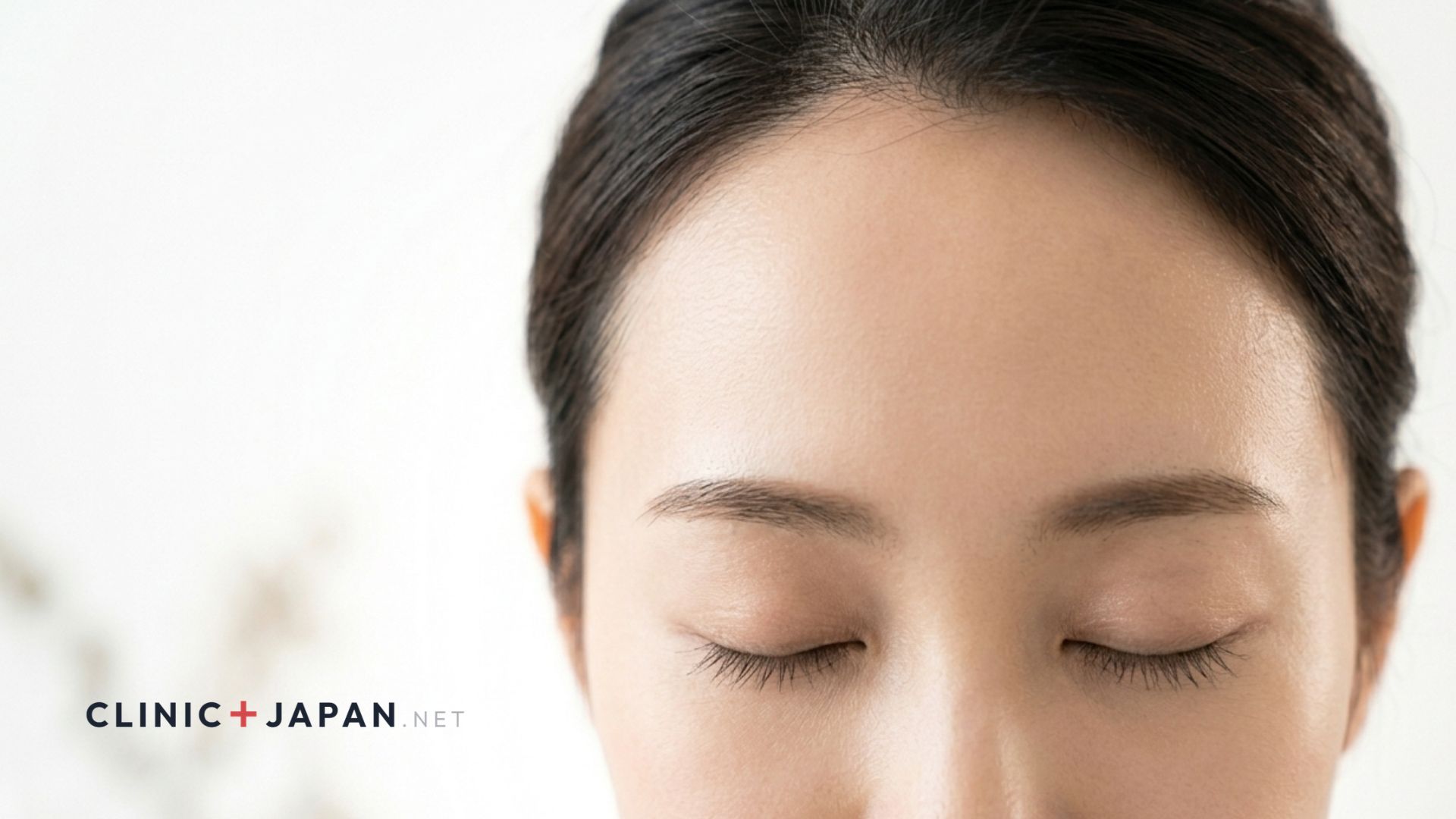 額ボトックス — おでこの横ジワ改善イメージ