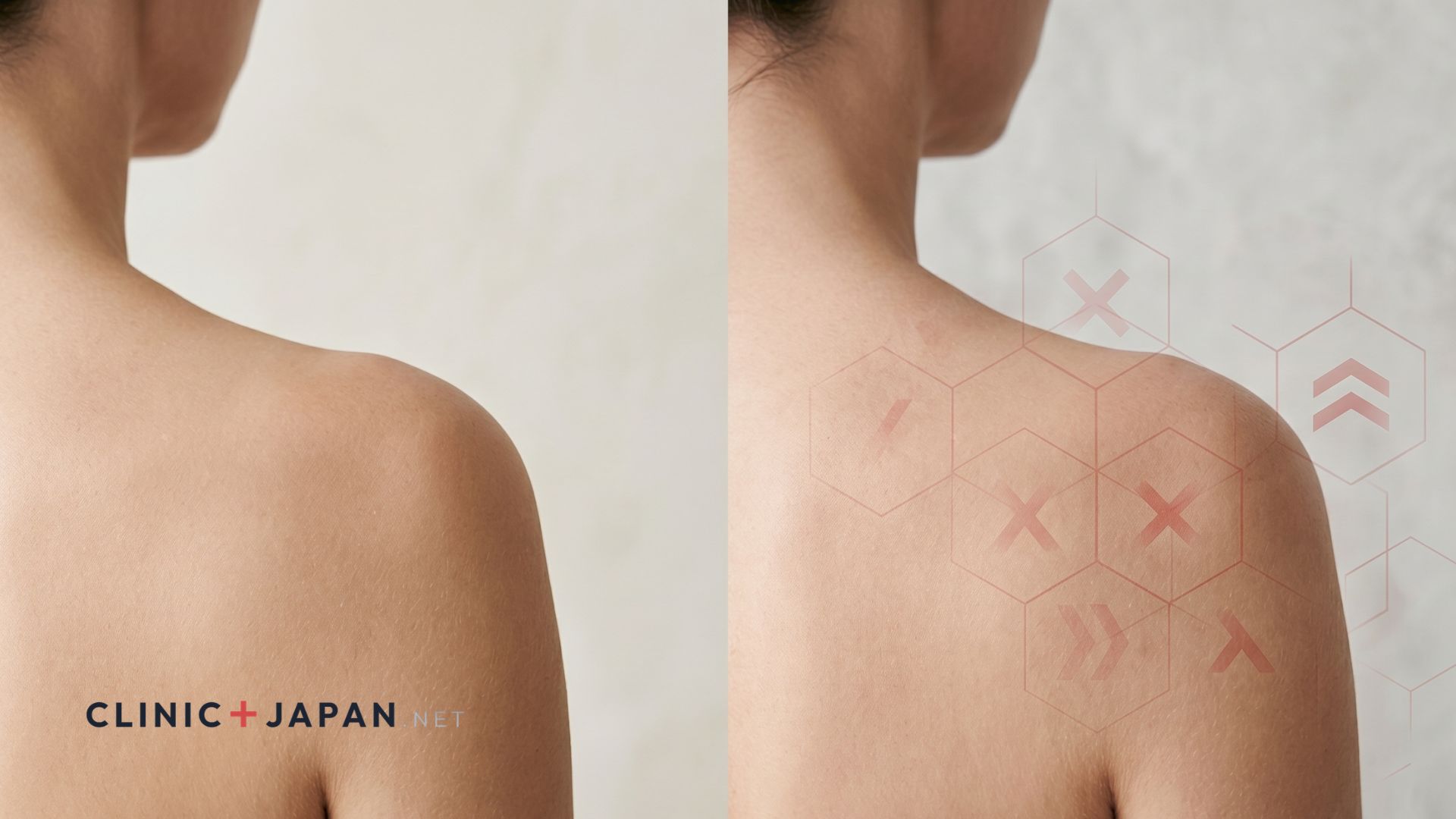 肩ボトックスのデメリット・リスク解説