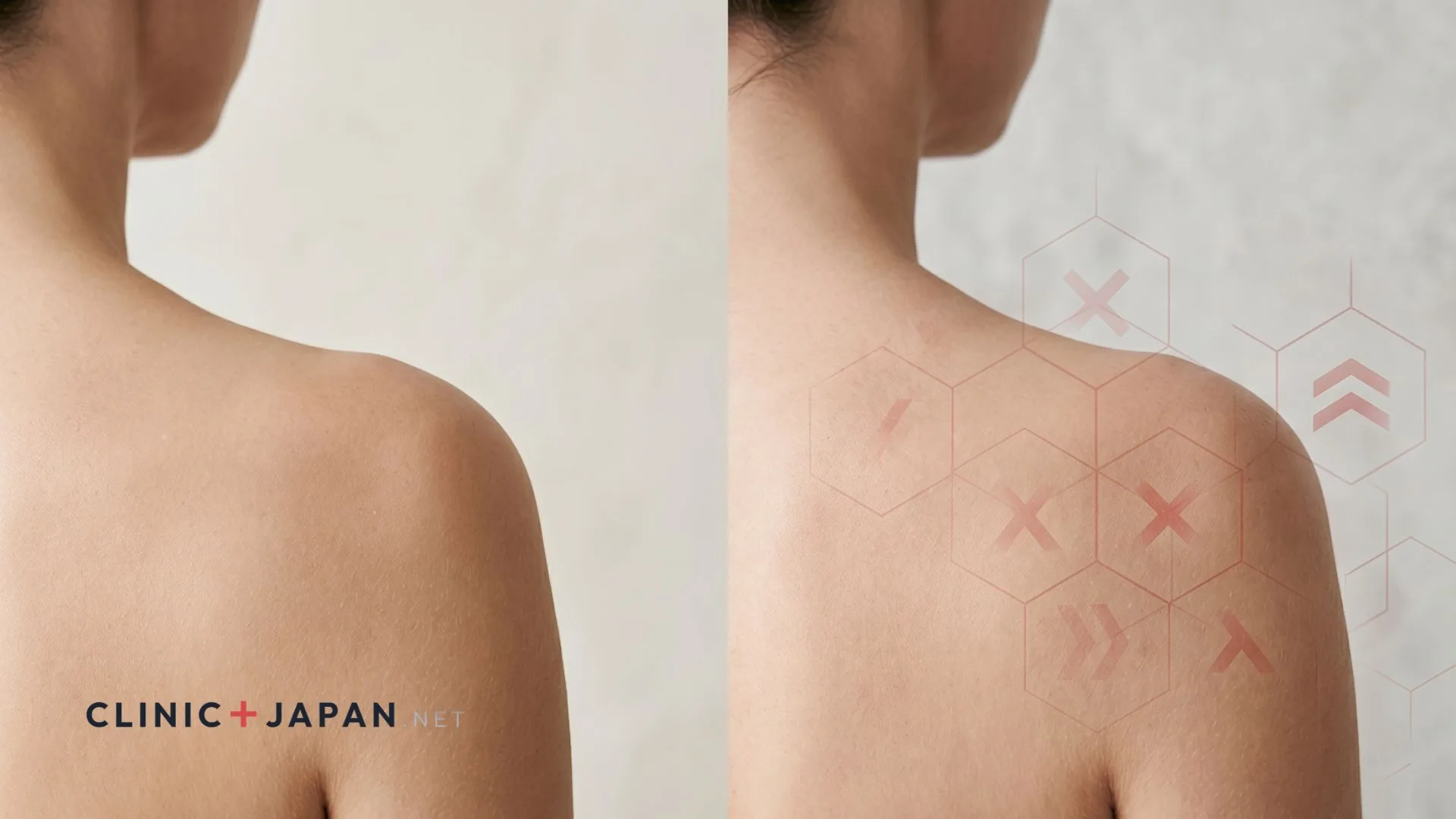 肩ボトックスのデメリット