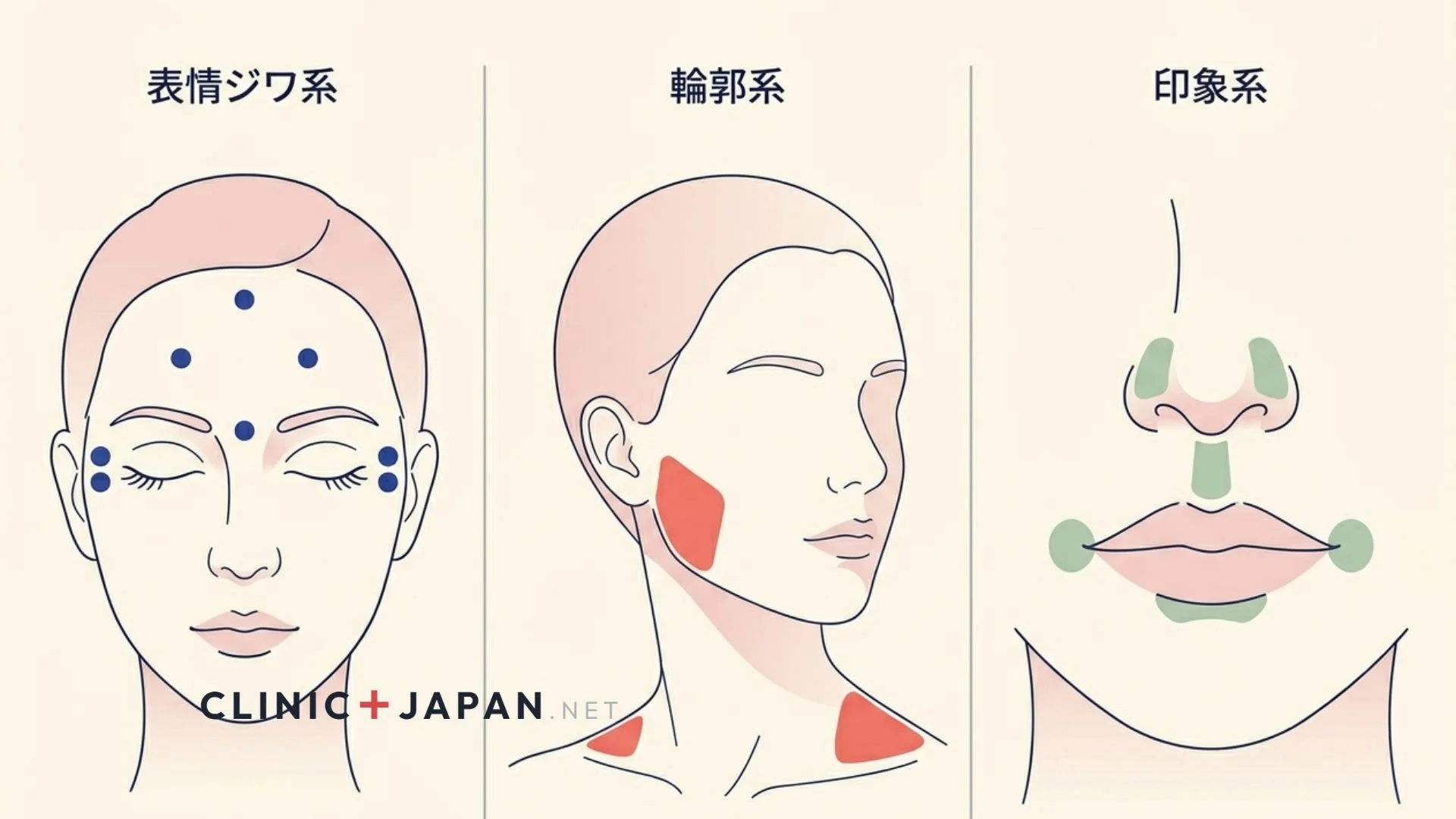 ボトックスの効果タイムライン図解 — 発現・ピーク・消失までの6か月