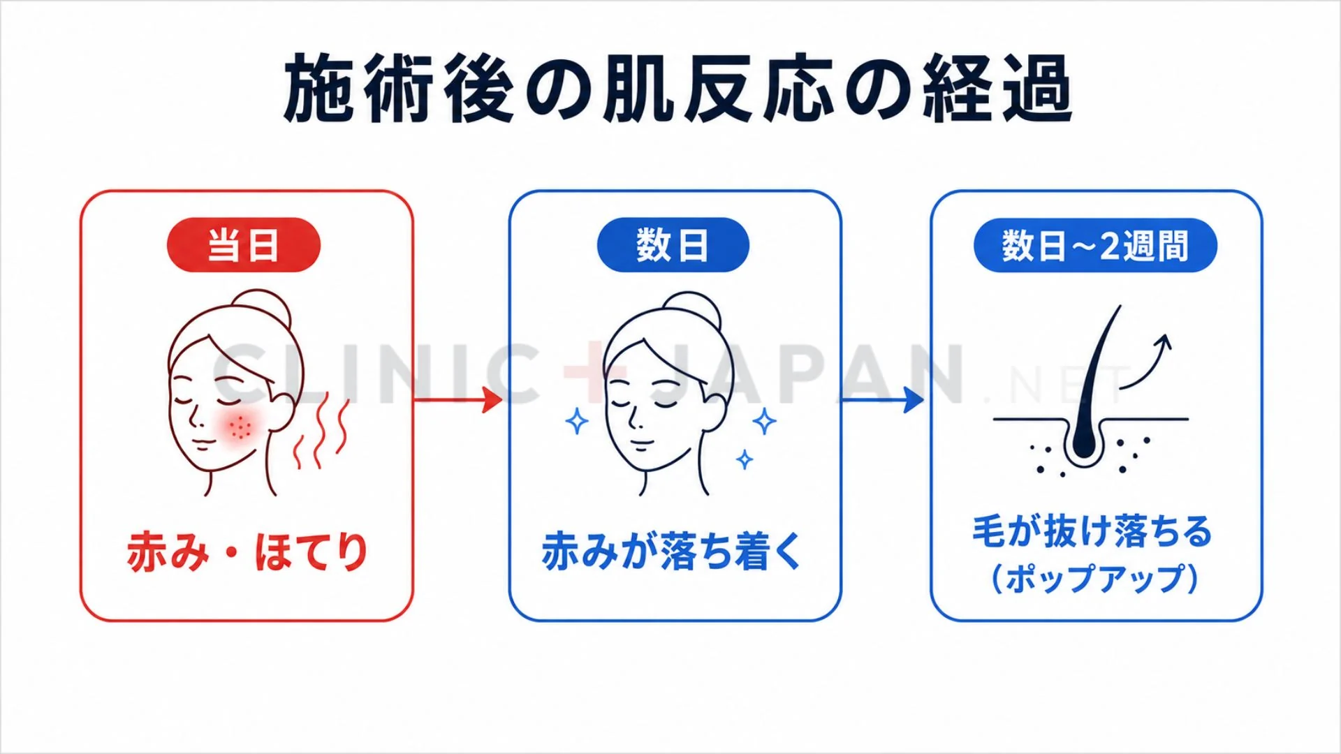 施術直後の赤みから毛の抜け落ちまで、施術後の肌反応の経過を時系列で示した図解