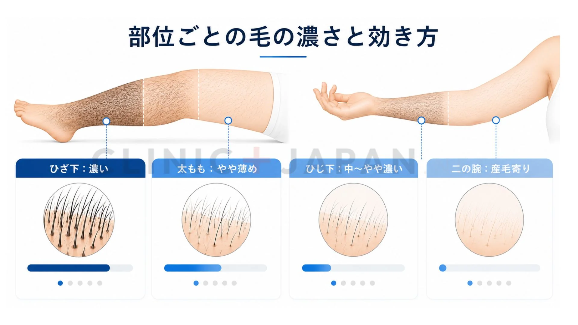 ひざ下は濃く効果が出やすく太ももや二の腕は産毛寄りで回数がかかりやすいことを示した部位別の図