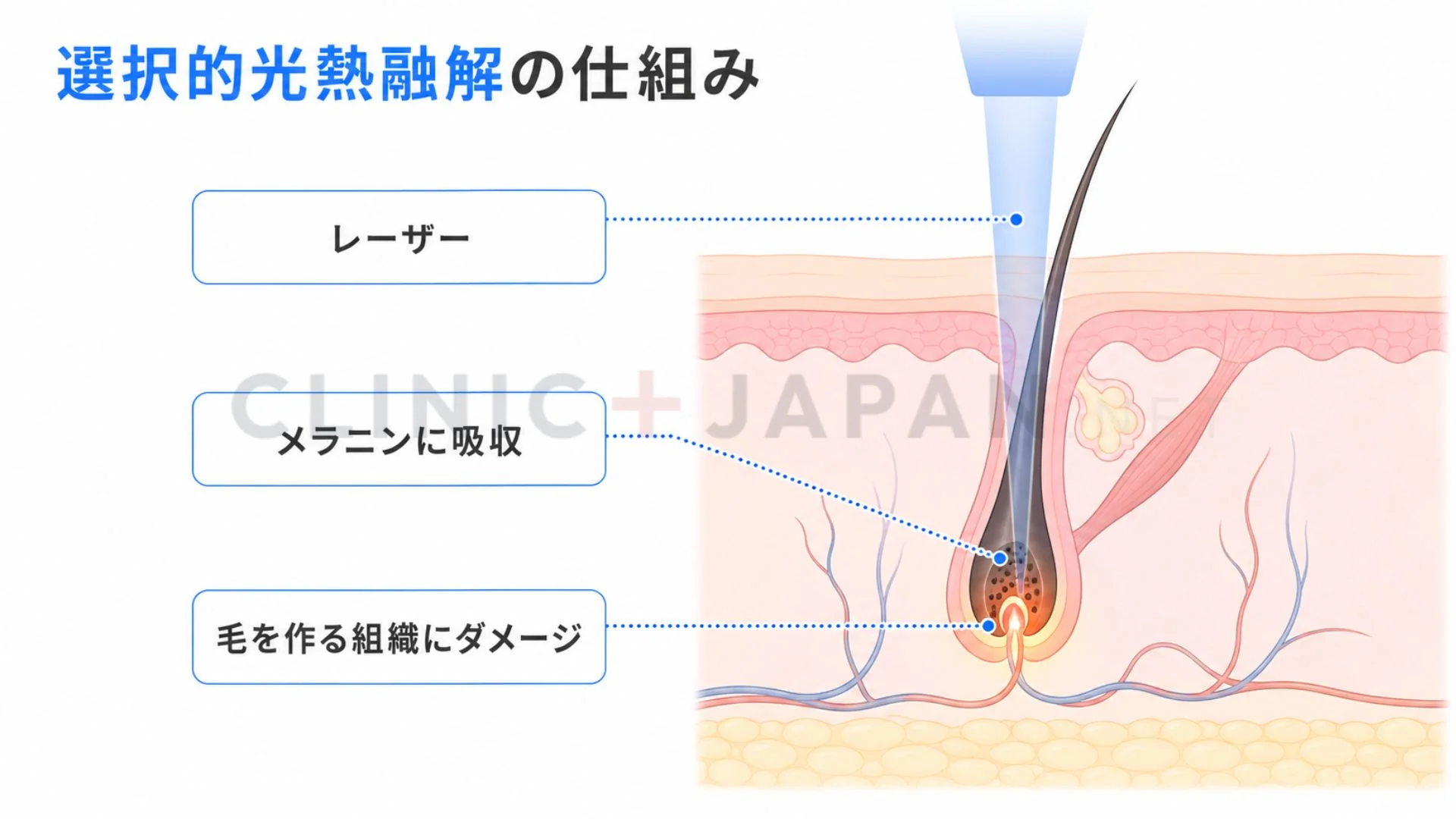 レーザーが毛のメラニンに吸収され選択的光熱融解で毛を作る組織にダメージを与える医療脱毛の仕組みを示した図
