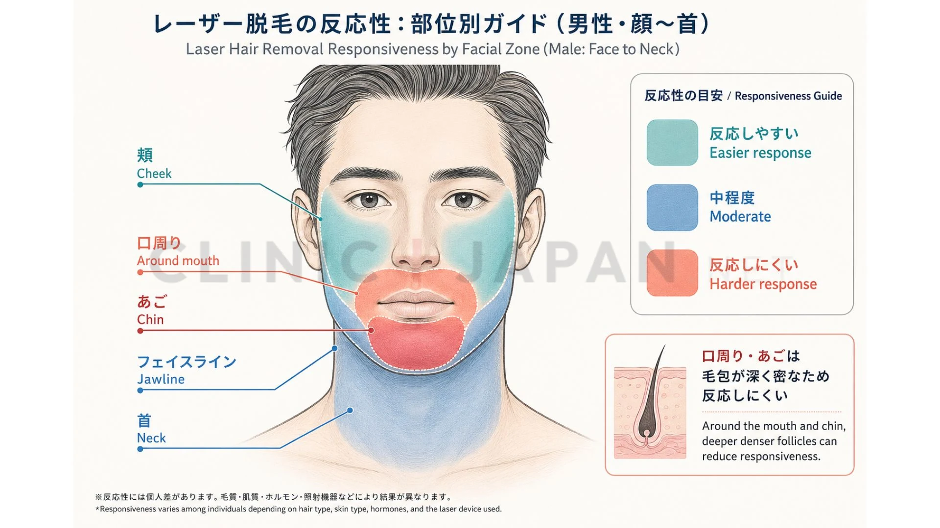 ヒゲ脱毛の回数ごとの経過を示した図解（1〜2回・3〜5回・6〜8回・10回以上）