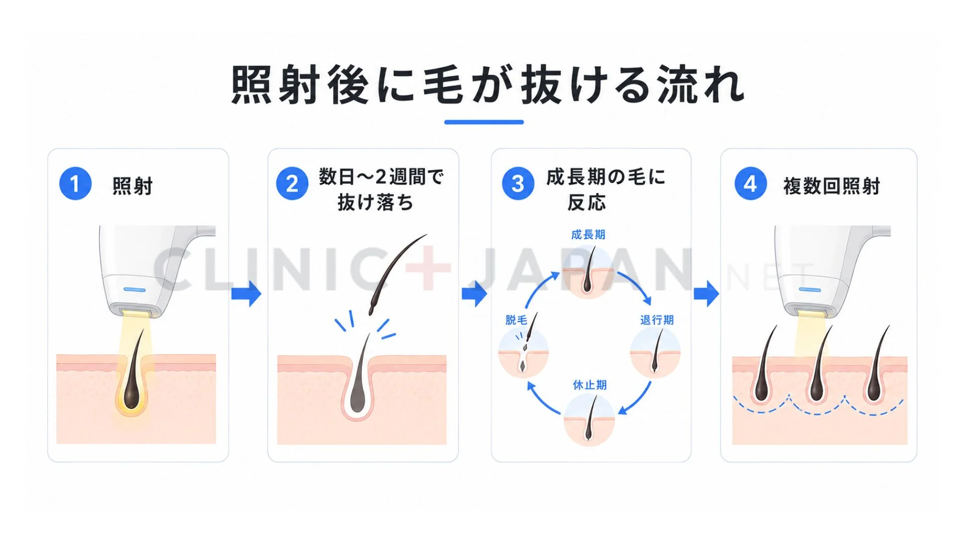 ヒゲ脱毛で照射後数日から2週間で毛が抜け落ち毛周期に合わせて複数回照射する流れを示した図
