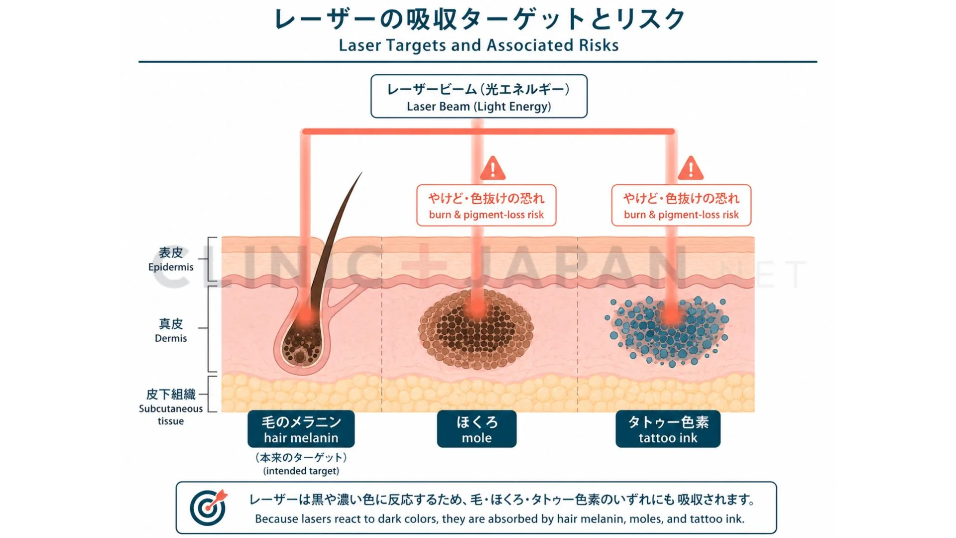 レーザーが毛のメラニンだけでなくほくろ・タトゥーの色素にも反応してしまう仕組みを示した概念図