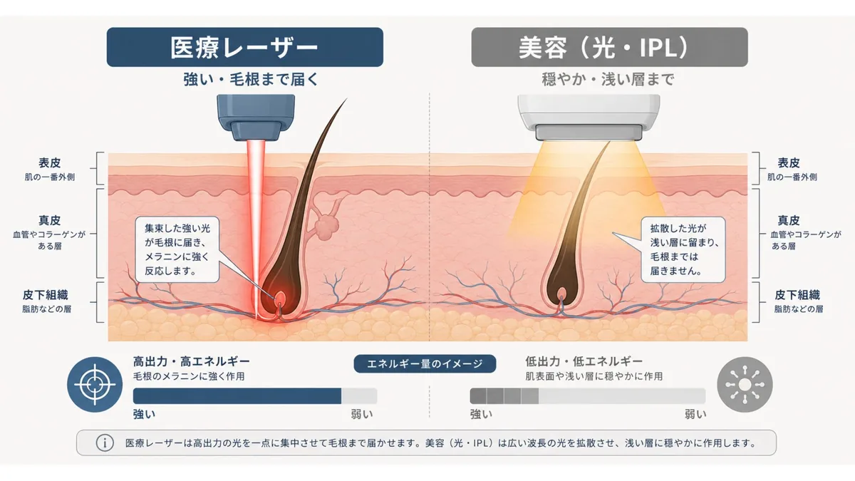医療レーザーと美容IPLの出力レベルの違いを示した図