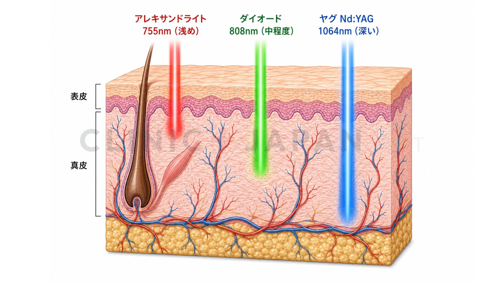 アレキサンドライト755nm・ダイオード808nm・ヤグ1064nmの波長別の皮膚到達深度を示した断面の模式図