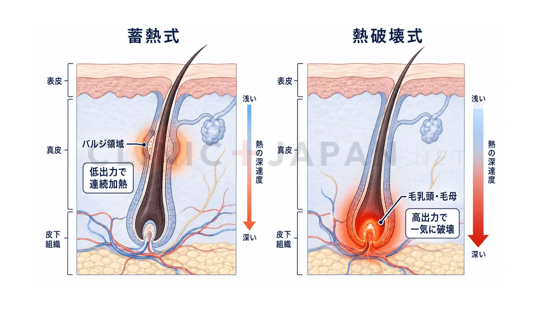 蓄熱式と熱破壊式の作用機序の違いを示した皮膚断面の模式図（バルジ領域と毛乳頭の標的の違い）