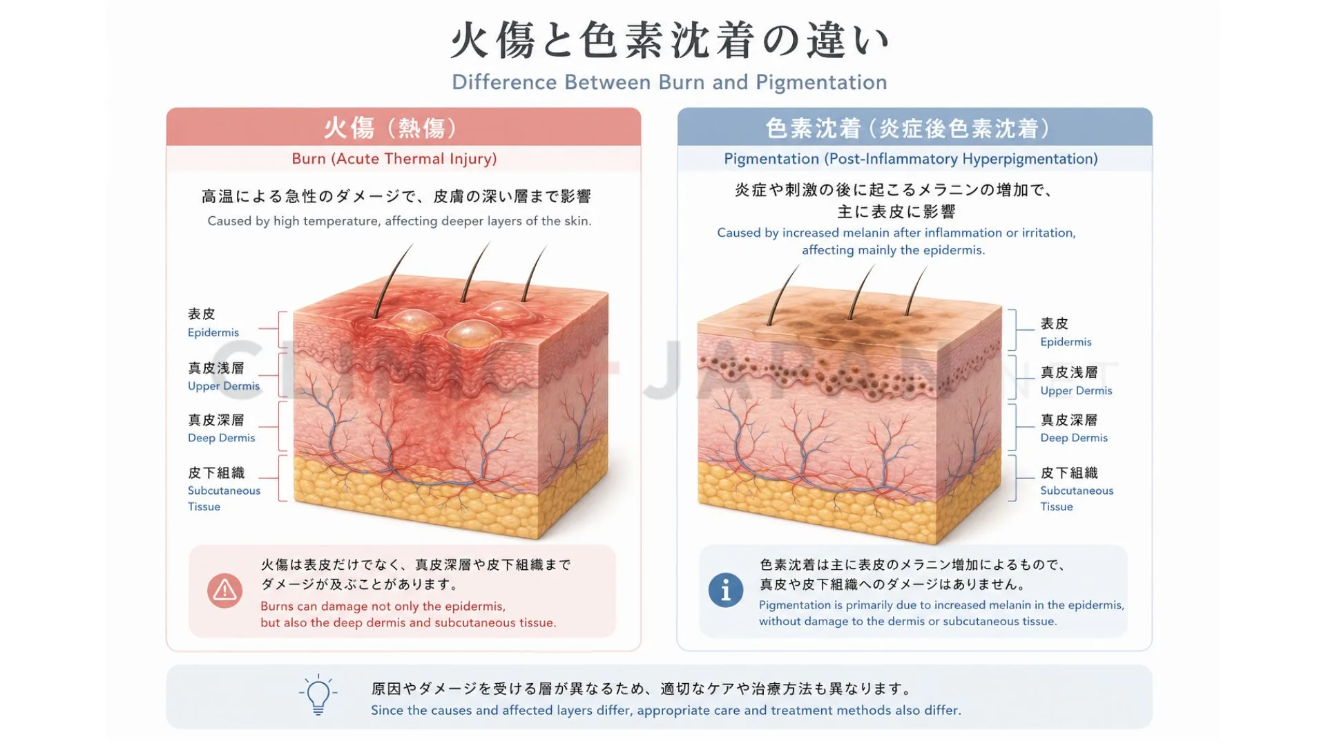 医療脱毛の肌トラブル — 火傷（熱傷）と色素沈着の違いと見分け方