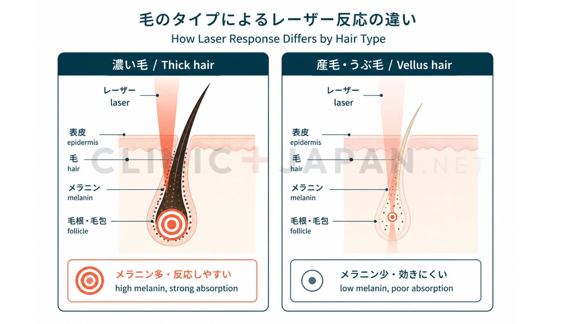 濃い毛はメラニンが多くレーザーが反応しやすく、産毛はメラニンが少なく反応しにくいことを対比した概念図