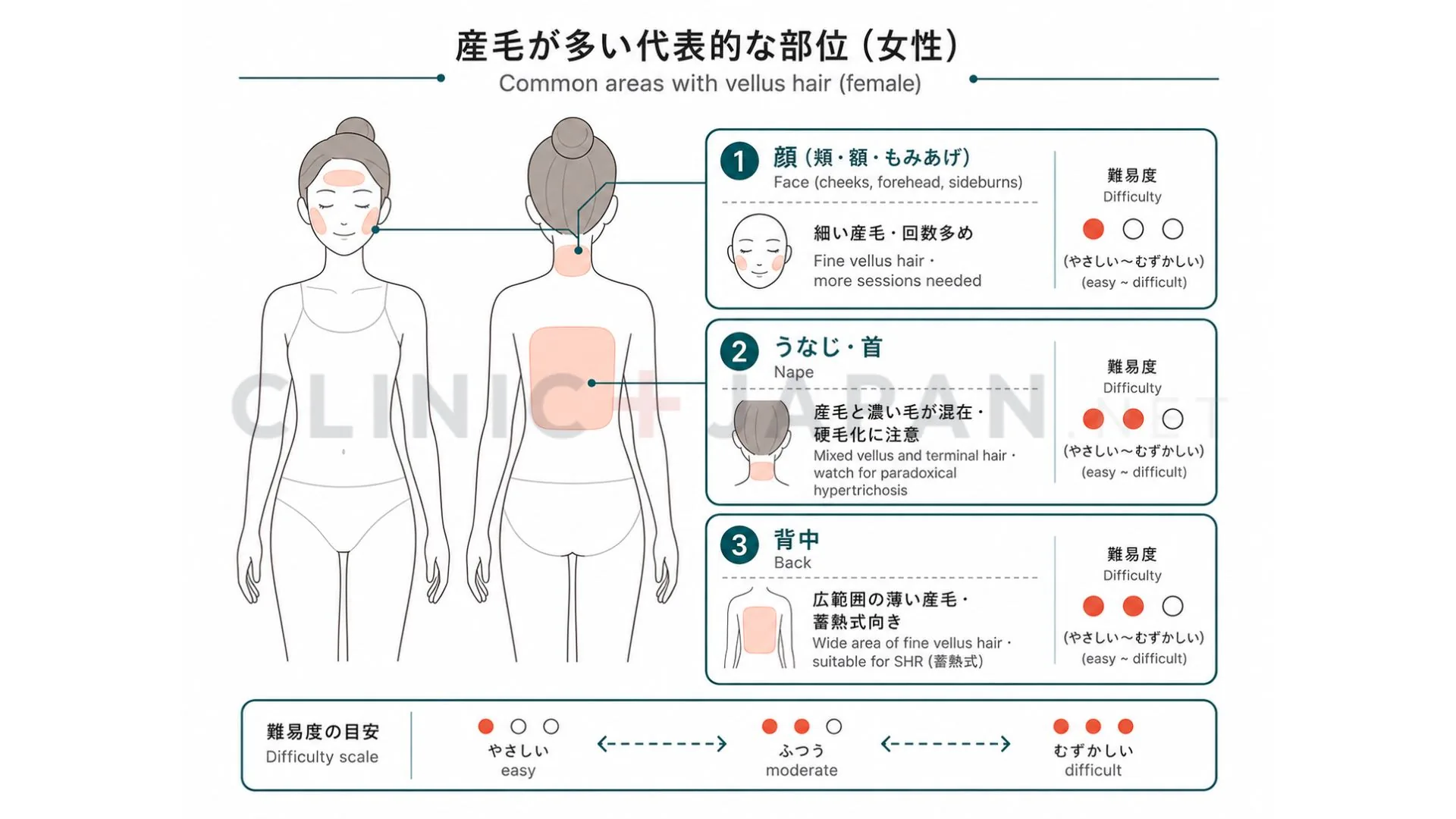 顔・背中・うなじなど産毛が多い部位と、それぞれの効きにくさ・回数の傾向を整理した図