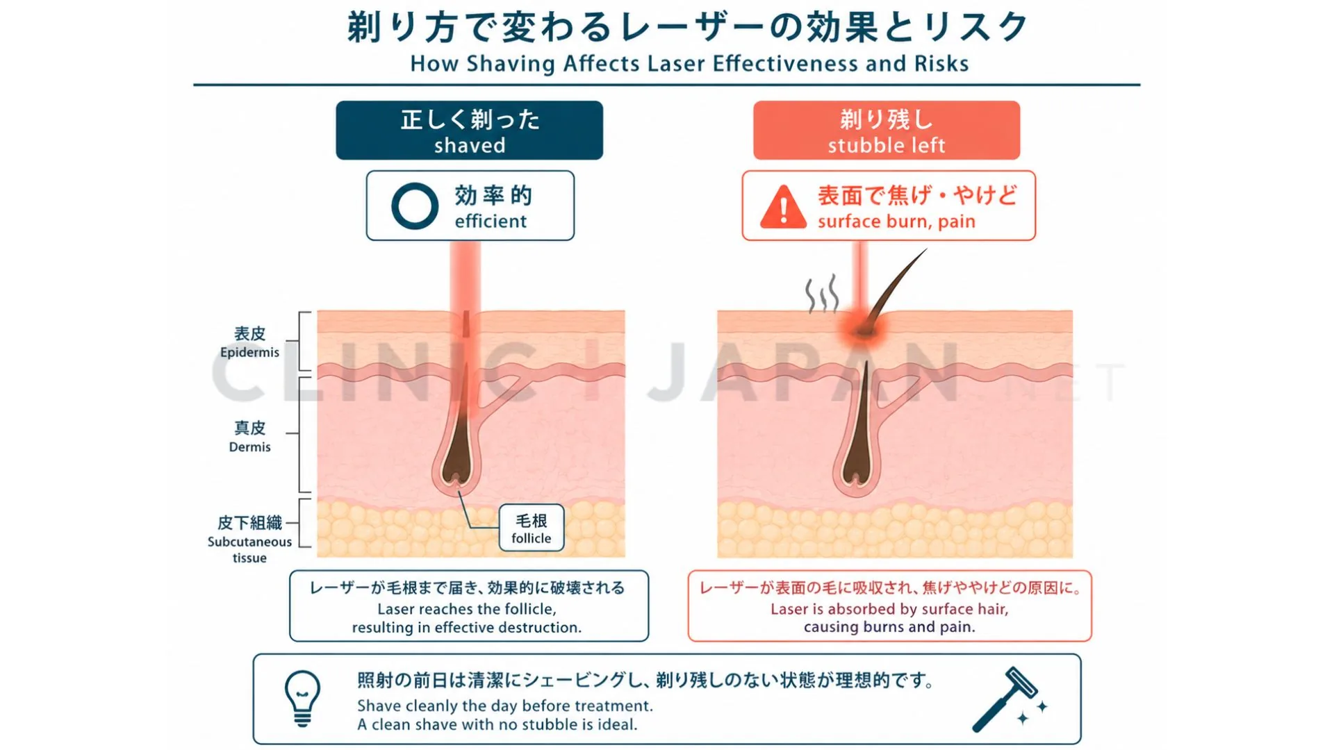 肌表面の毛を剃るとレーザーが毛根だけに届き、剃り残しがあると表面の毛が焦げてやけどになる仕組みを対比した図