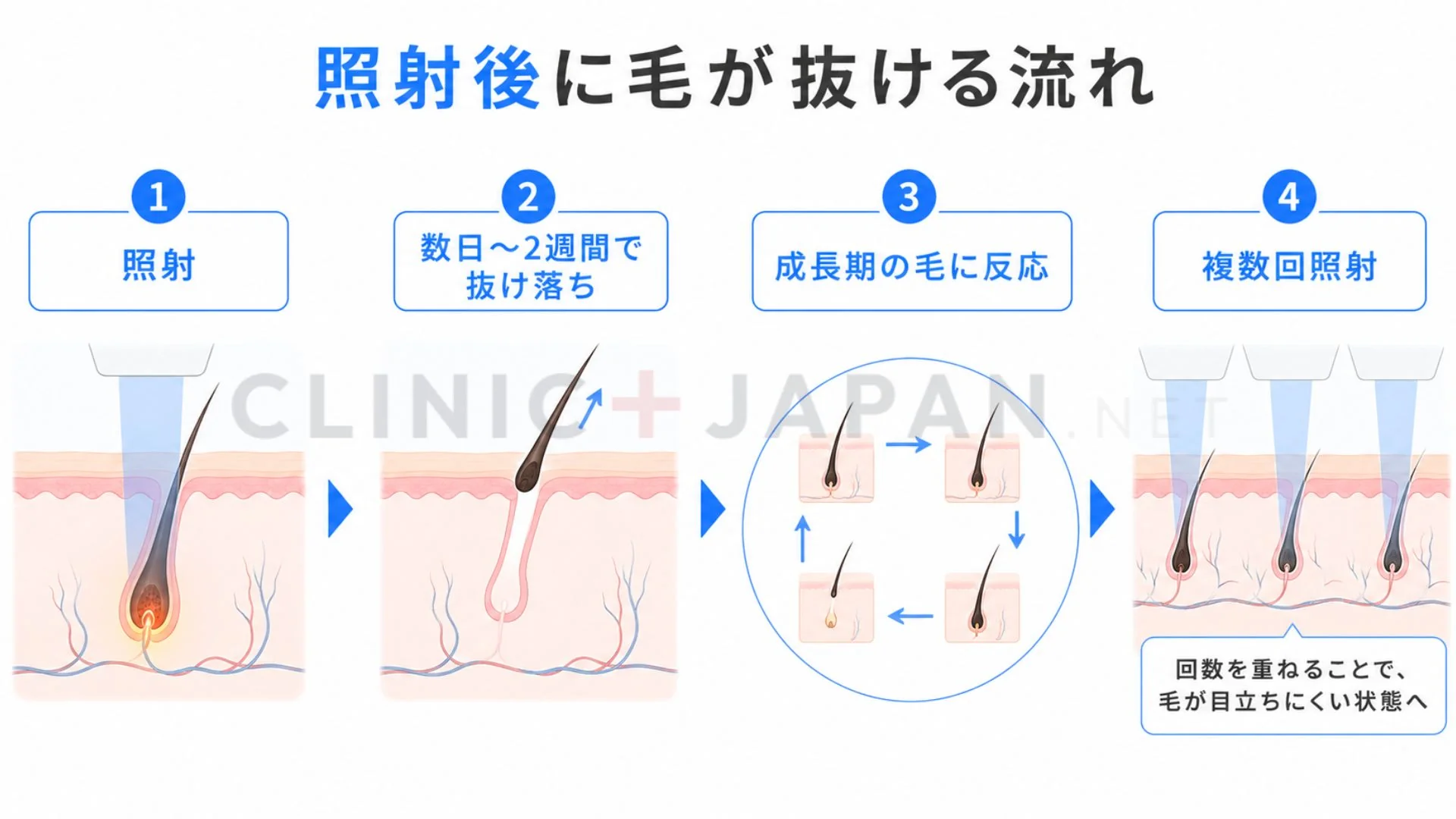 VIO脱毛で照射後数日から2週間で毛が抜け毛周期に合わせて複数回照射する流れを示した図