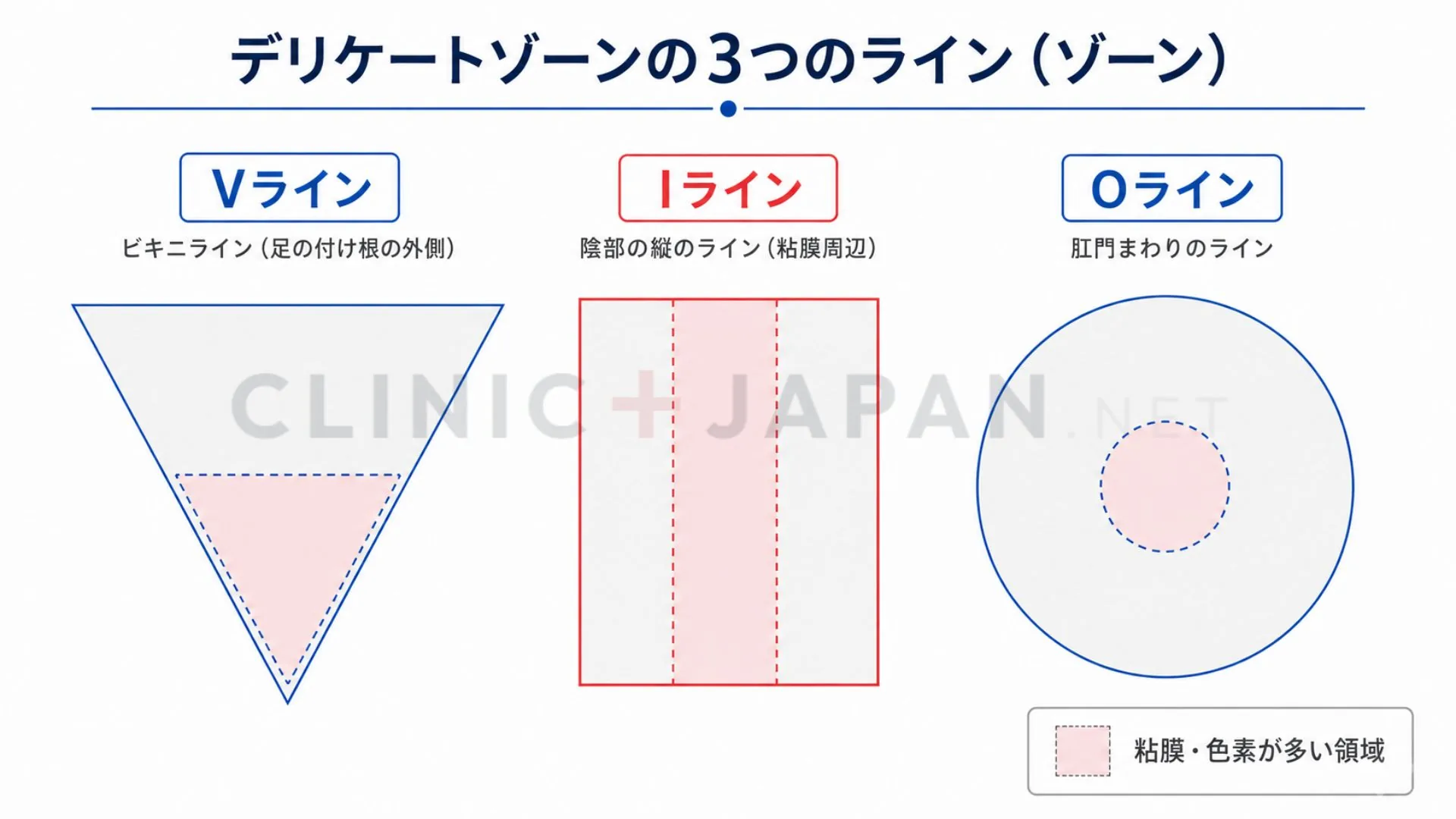 V・I・Oの部位区分と粘膜・色素が多い領域を示した概念図（非露出の模式図）