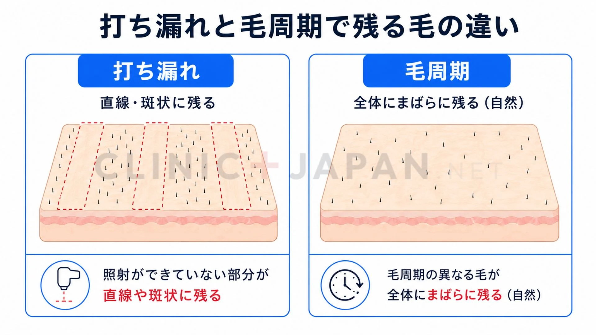 打ち漏れで直線状に残る毛と、毛周期で自然に残る毛の違いを示した図解