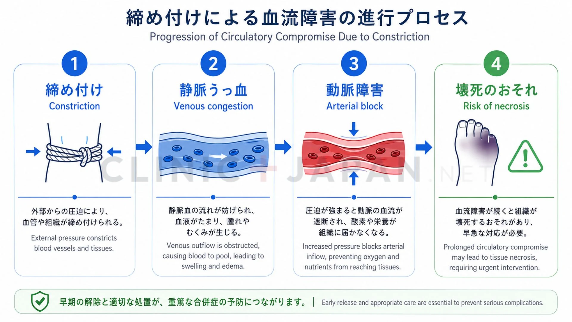 カントン包茎で包皮が締め付けることで、うっ血から血流障害へ進む流れを段階的に示した図