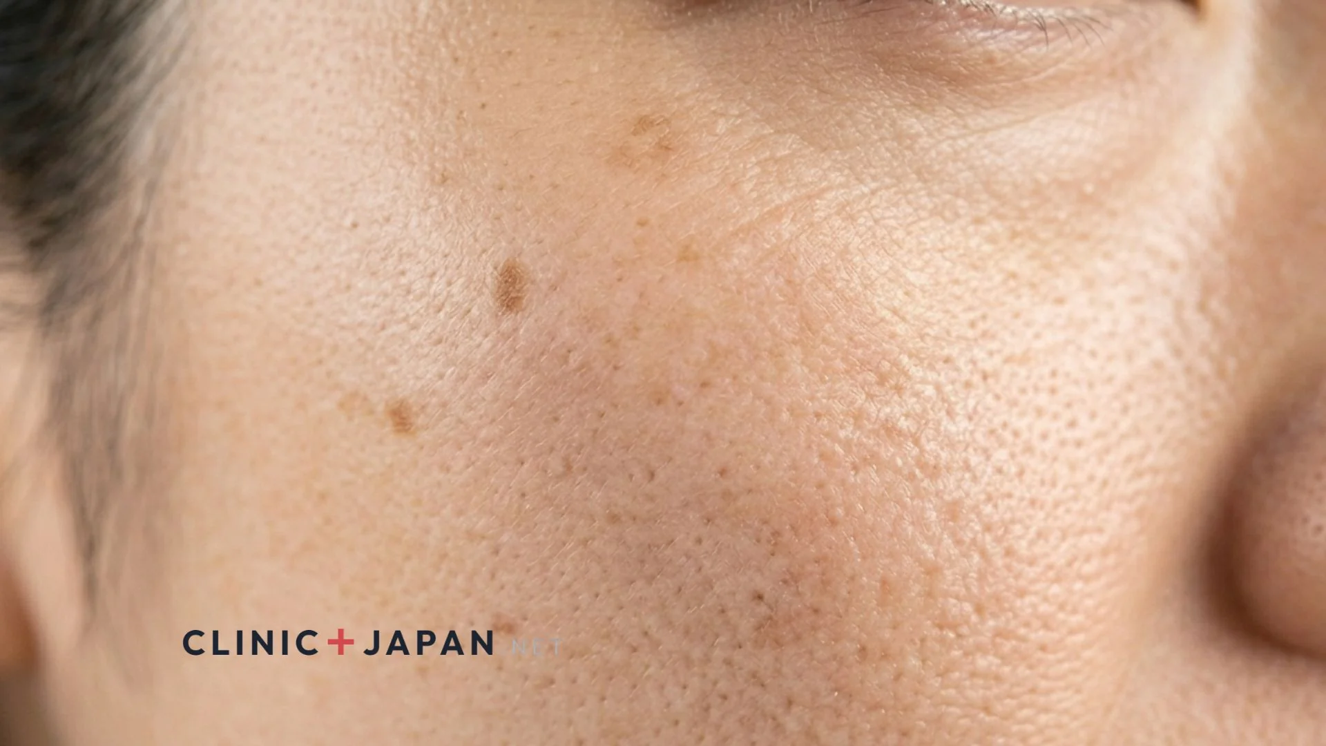 シミの種類別治療の比較 — 老人性色素斑・肝斑・ADM・脂漏性角化症の見分け方