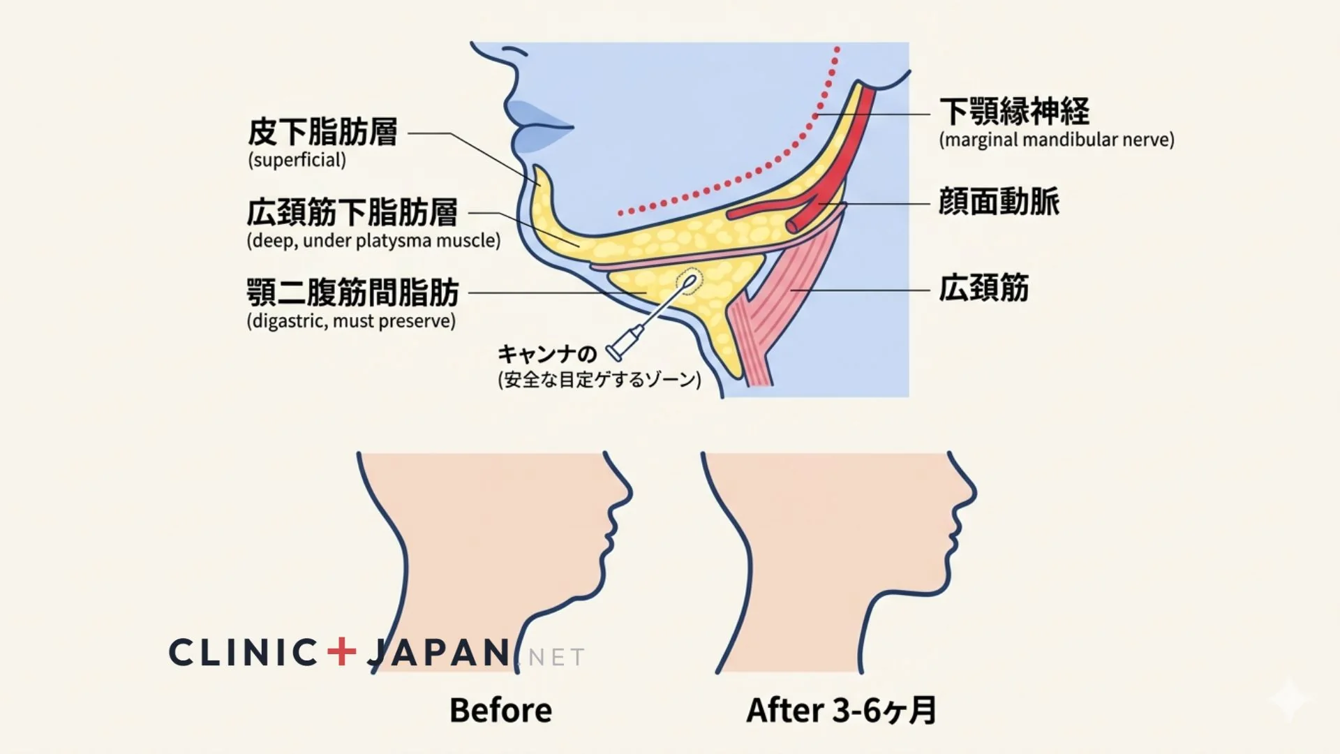 顎下脂肪吸引の解剖と効果イメージ
