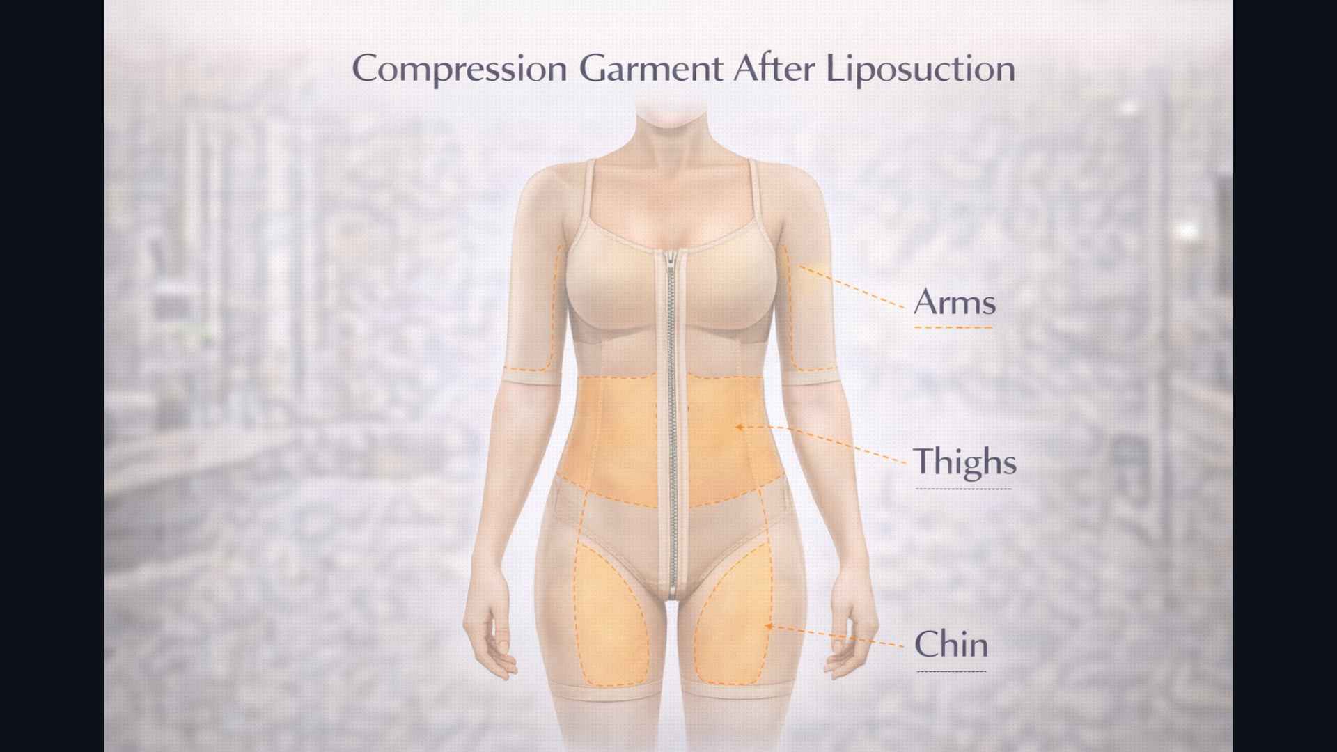 Medical illustration of compression garment worn after liposuction procedure