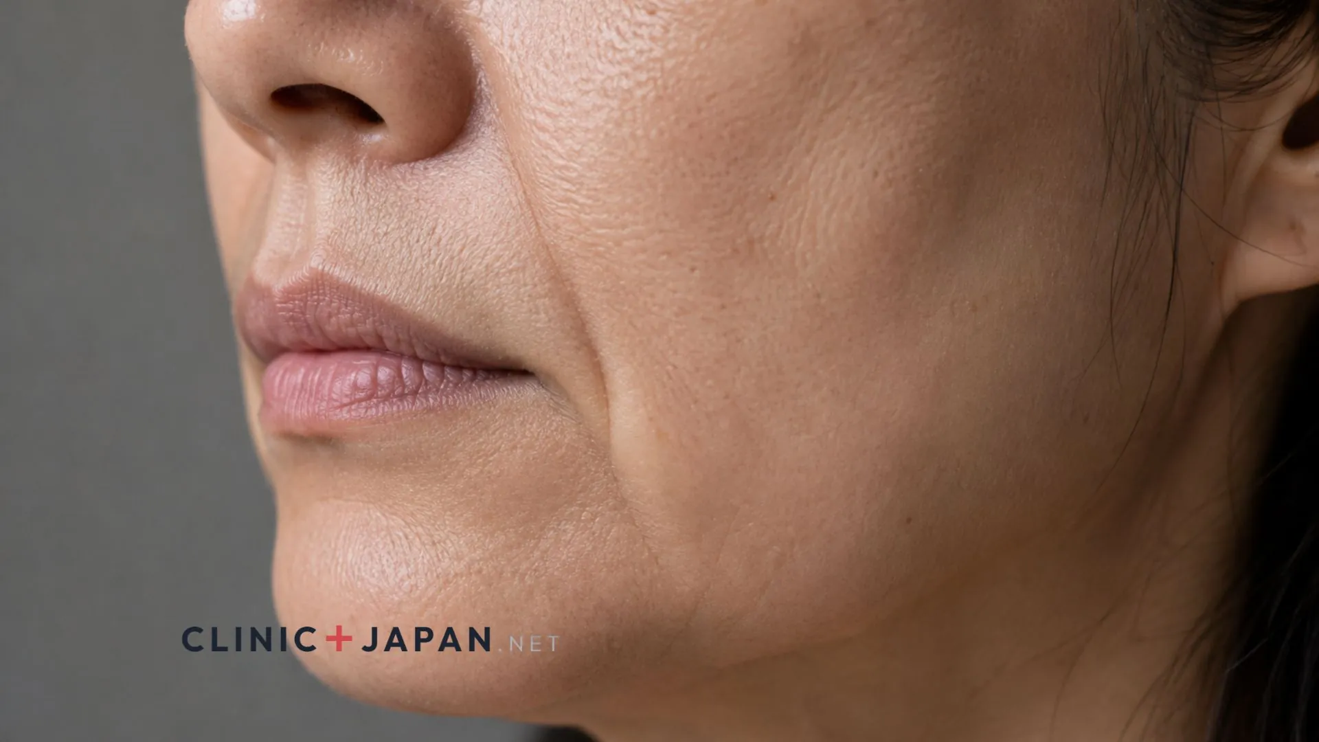 Profile view of the lower face showing the fold running from the corner of the mouth towards the jawline
