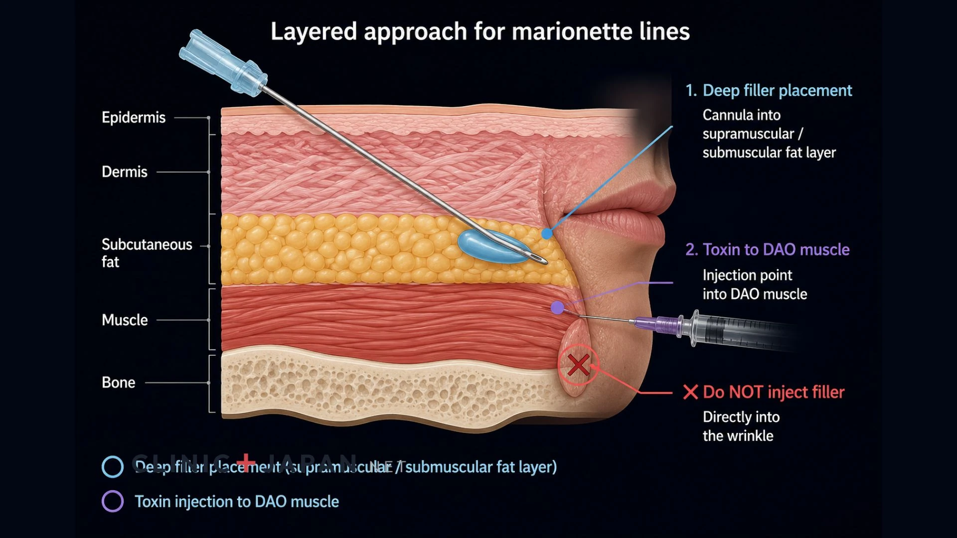 Diagram showing a layered treatment approach to the lower face with deep filler placement at the mouth corner and toxin at the depressor anguli oris