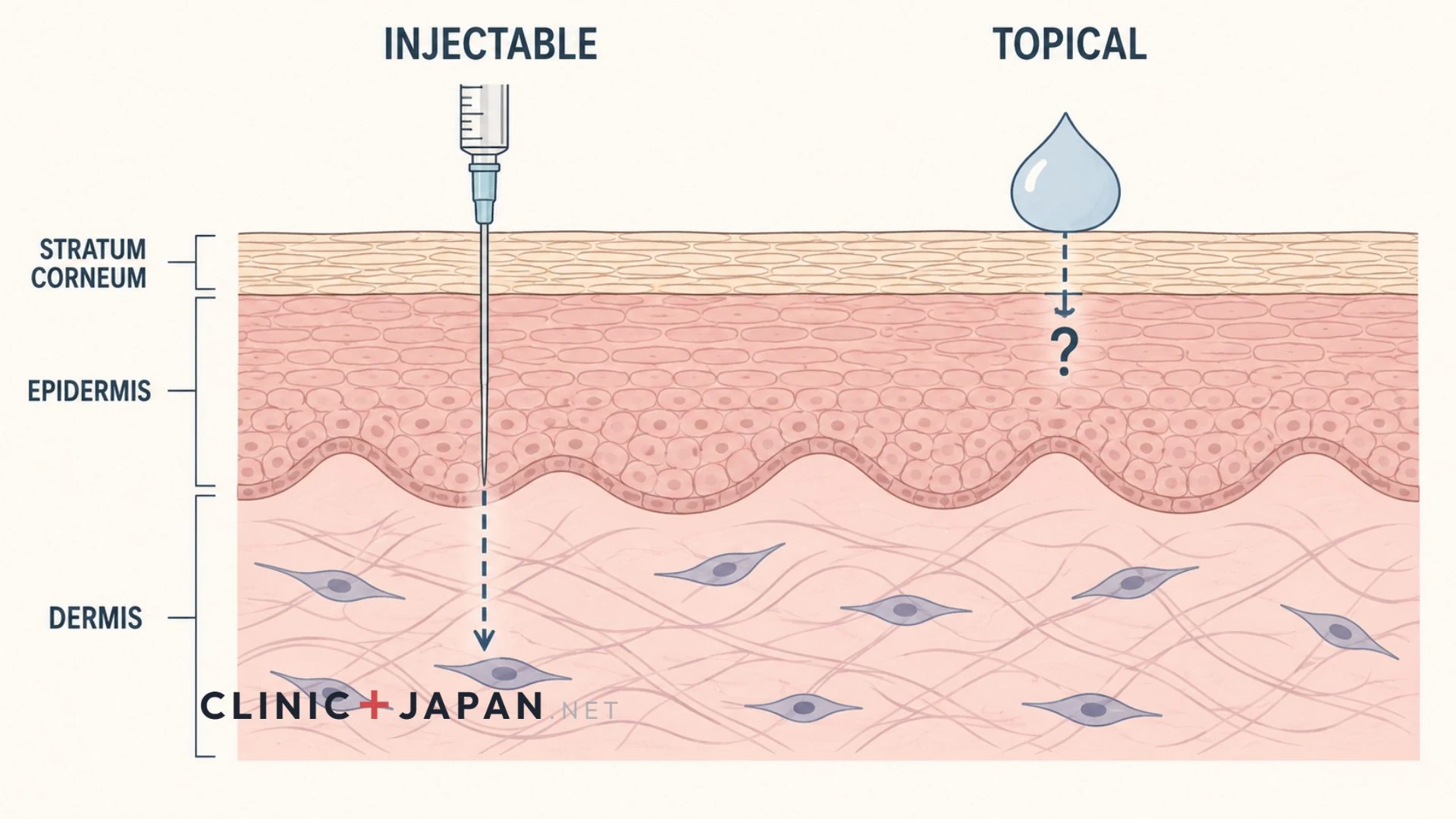 Cross-section diagram of skin contrasting an injectable delivering PDRN into the dermis with a topical serum sitting on the stratum corneum
