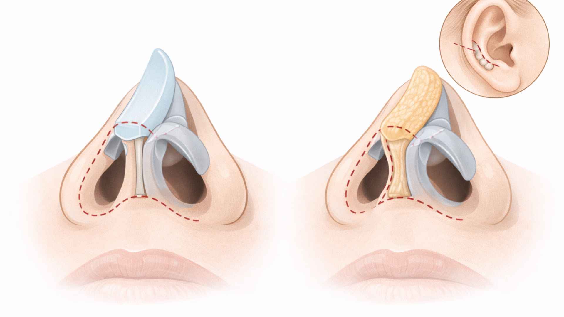 Medical illustration comparing silicone implant and ear cartilage grafts for nose surgery